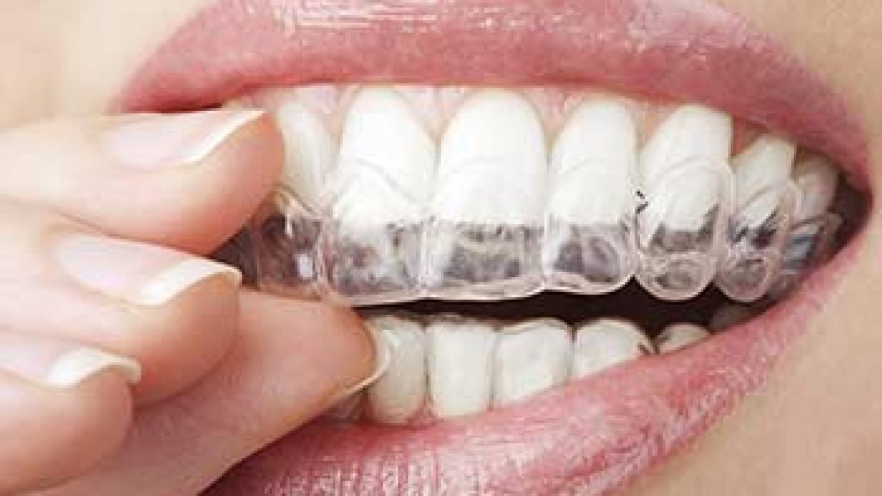 What is Invisalign? 5 Benefits of Invisalign in Waterloo ON
